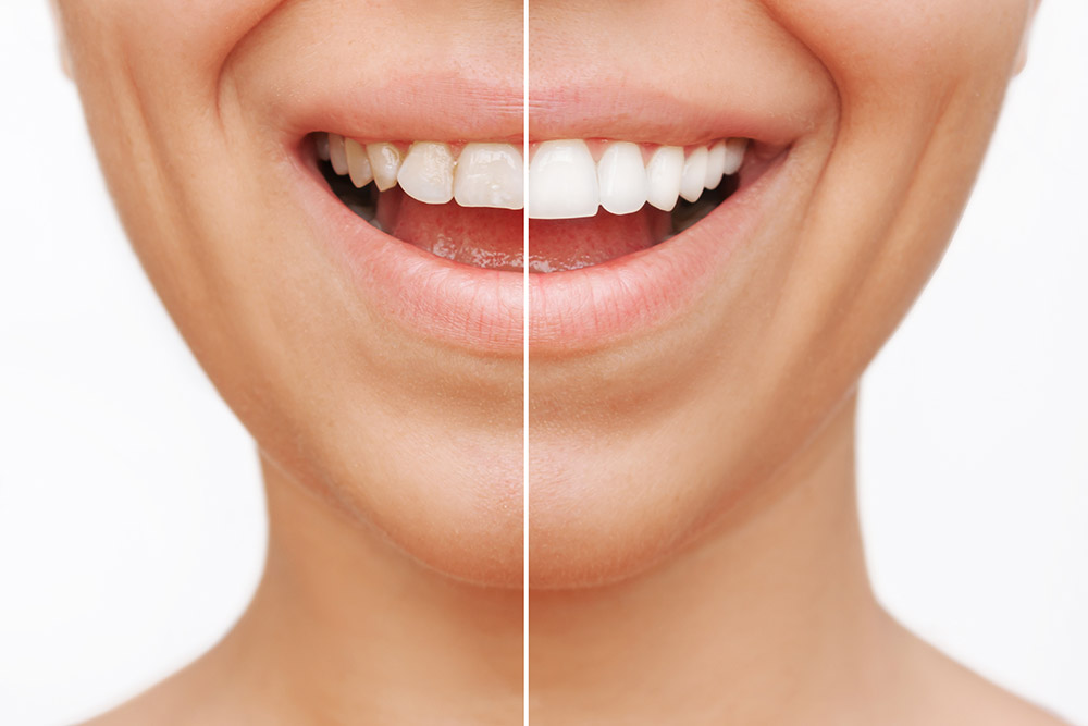 Dental Veneers in North York