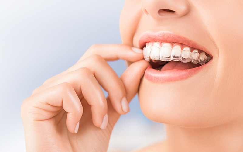 Invisalign in North York