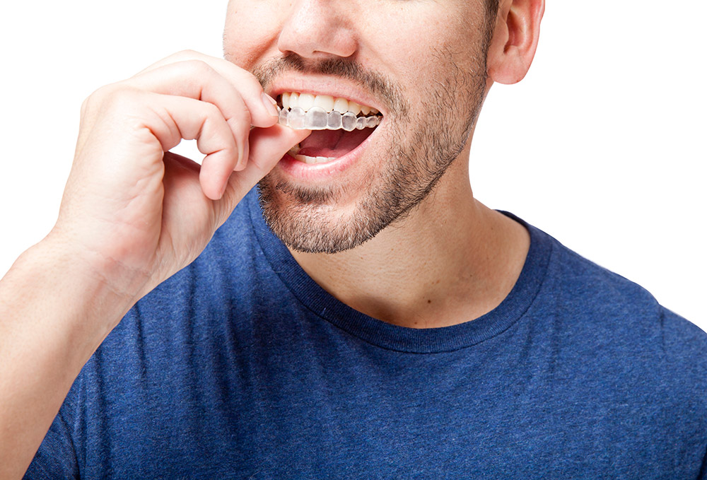 Invisalign in North York