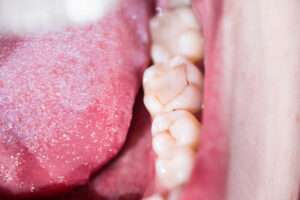 how dental fillings help prevent further tooth damage