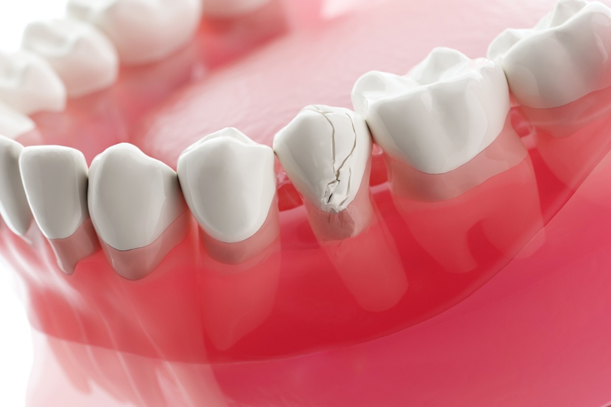 crown for a large tooth crack