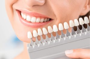 veneers for a gummy smile